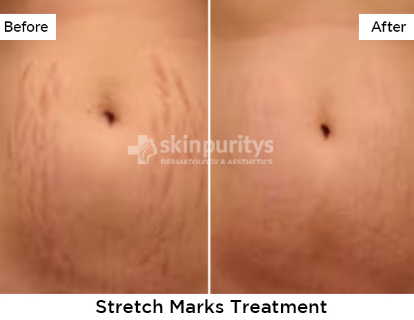 Stretch Marks results